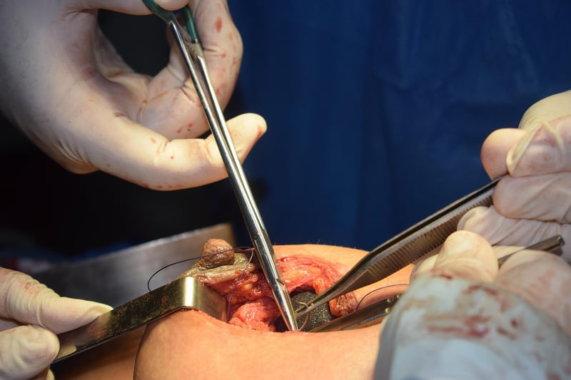 Facelift Surgery